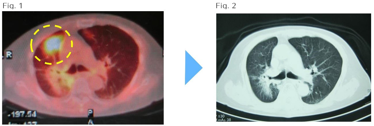 Patented Immunotherapy Technology ｜ Tokyo Cancer Clinic